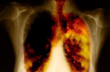 behandling av lungcancer 4 grader